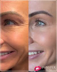 Treatments for aging eyes: From skin care products to lasers to surgery, Dr  Roth discusses it all. Dr Roth loves SkinCeutical's Retinol, B5 Gel and AOX  Eye. For stronger results, he recommends
