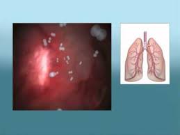 What are the types of copd (chronic obstructive pulmonary disease)? Ù…Ø§ Ù‡Ùˆ Ù…Ø±Ø¶ Ø§Ù„Ø¥Ù†Ø³Ø¯Ø§Ø¯ Ø§Ù„Ø±Ø¦ÙˆÙŠ Ø§Ù„Ù…Ø²Ù…Ù† Copd Youtube
