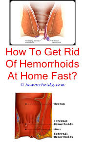 External Hemorrhoids Can You Use Witch Hazel Wipes On Hemorrhoids What Do You Do For Hemorrhoids Ins Bleeding Hemorrhoids Hemorrhoids Treatment Hemorrhoids
