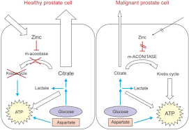 The pancreas is a bodily organ that few people think about. Metabolomics A Novel Approach To Early And Noninvasive Prostate Cancer Detection Abstract Europe Pmc