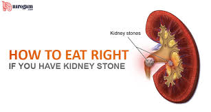 indian diet for kidney stone how to eat right if you have