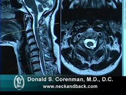 In a prospective multicenter study, two blinded raters independently examined cervical spine magnetic resonance (mr) images of 140 healthy . How To Read A Mri Of Cervical Stenosis With Spinal Cord Injury Spine Surgeon In Colorado Spinal Stenosis Stenosis Spinal Cord Injury
