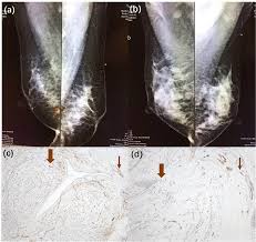 Generally cancers are more dense than surrounding tissue, which can be a clue and the tumor can look darker or lighter than. X Ray Mammography Results Of The Same A Invasive Breast Cancer And Download Scientific Diagram