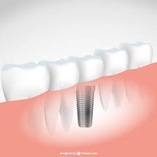Baixe Dental Ilustracao Vetorial Implante Gratuitamente In 2020 Dental Crowns Dental Implants Dental Cosmetics