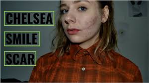 A glasgow smile (also known as a chelsea smile, or a glasgow, chelsea, birkenhead, a buck 50 or cheshire grin) is a wound caused by making a cut from the corners of a victim's mouth up to the ears. Natural Chelsea Smile Scar Sfxamy Youtube