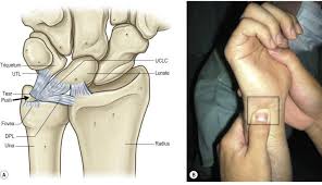 Последние твиты от ruptur (@rupturecobleue). Tfcc Yaralanmalari Triangular Fibrokartilaj Kompleks Istanbul Elcerrahisi