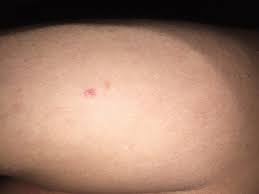 Image result for spinne biss haut reaktion