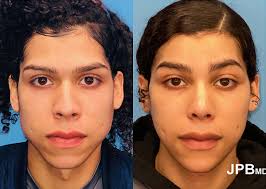 Facial Feminization Surgery in NYC