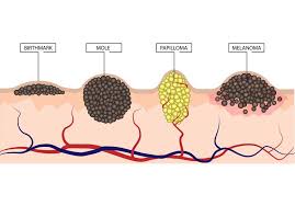Skin cancers can look very different and the symptoms can vary. Early Signs Of Skin Cancer