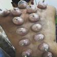 Cupping Therapy product image