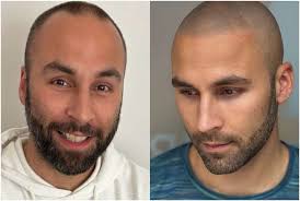 Top 13 Liverpool scalp micropigmentation artists compared