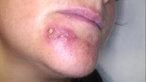 Si les croûtes dans le nez sont liées à une sécheresse de l'air, par exemple en raison du chauffage en hiver, l'utilisation d'un humidificateur peut. Dermato Info Les Infections Bacteriennes