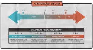 what is a fibroscan hepatitis c treatment