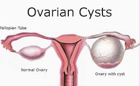 Ini merupakan gejala mental yang membuat pengidapnya mengalami kebingungan berat dan kesadaran yang berkurang akibat. Makan Supplemen Tak Boleh Rawat Ovarian Cyts Doktor Nasihat Wanita Supaya Tak Tertipu