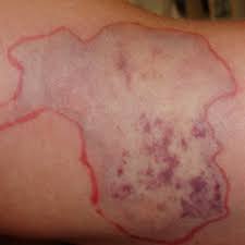 Image result for yellow sac spider bite skin