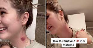 Want To Know How To Get Rid Of A Hickey? Let Tiktok Be Your Muse