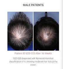 Receding or thinning crown basic logic will play well here. Durham Startup Clinical Trial Results Prove It Has Cure For Baldness Wral Techwire