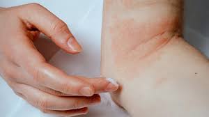 Spiritual meaning of eczema hives itching psoriasis vitiligo. 6 Types Of Eczema Symptoms And Causes