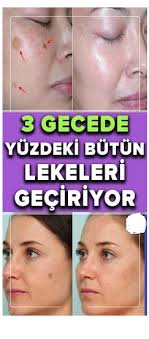Yuzdeki Lekeleri Hizli Geciren Yontem Skin Detox Spots On Face Homemade Skin Care