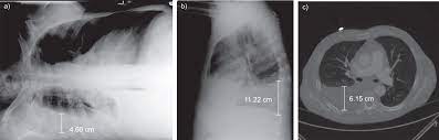 Pleural effusions accompany a wide variety of disorders of the lung, pleura, and systemic chest pain associated with pleural effusion is caused by pleural inflammation of the parietal pleura resulting from increase the drain in patients with multi loculated parapneumonic effusion or empyema. Computed Tomography Measurements Of Parapneumonic Effusion Indicative Of Thoracentesis European Respiratory Society