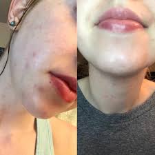 You can get an active form of vitamin a from most supplements will give you close to 5,000 iu per day. Vitamin A And Acne Reddit Vitaminwalls