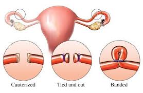 Women Must Know This Before Deciding Female Sterilization Tubal Ligation