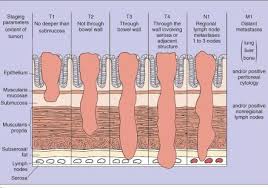 Pin On Rectal Cancer