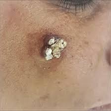 Image result for cornu cutaneum)