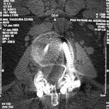 Axial Ct Demonstrating Facet Joint Fusion Download Scientific Diagram