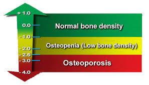 Bone Density Chart Understand Your Bone Density Scores