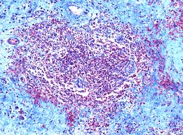 Radu & tudor hip hop la nunta •••. Area Of Cholecyst Wall Intensely Infiltrated With Lymphocytes Gs Download Scientific Diagram