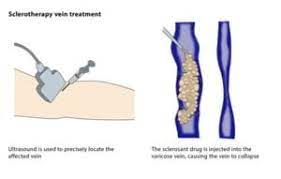 Achillespeesontsteking Echozorg Biedt Een Effectieve Behandeling