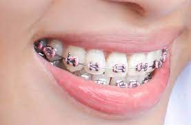 You must understand when and how to brush your teeth with braces to assist combat dental issues. If You Wear Braces Here S How To Brush Your Teeth