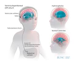 Image result for Hydrocephalus