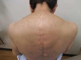 Image result for Diffuse Hyperpigmentation