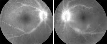 Scielo Brasil Birdshot Retinochoroidopathy Review Birdshot Retinochoroidopathy Review