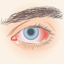 Image result for Allergic Conjunctivitis
