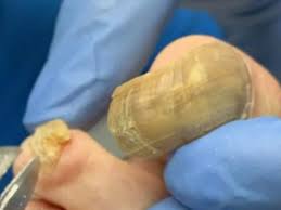 Mais imagens de stock similares. Cancer De Unha Pode Ser Confundido Com Micose Saiba A Diferenca Noticias R7 Saude