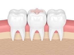 How long does it take?. Grey Or White Fillings In Laval Carrefour Dentaire 440