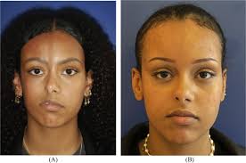 Autologous adipose tissue transfer in progressive hemifacial atrophy: From  simple volume to regenerative cell therapy