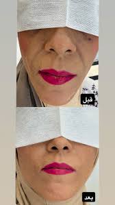 ضعفت 12 كيلو بشهر 🔥🔥🔥 علاج التنحيف وتنزيل الوزن الاول بالبلاد في عيادة  سوبر دكتور ! لحجز دور/ استفسار 0545540413 ☎️ . . #سوبر_دكتور #سوبردكتور  #عيادة #تجميل #تنحيف #تخسيس #انقاص_الوزن #شفاعمرو