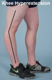 Here's how strong you can get naturally (with calculators), according to science. Hyperextended Knee Symptoms Causes Treatment