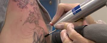 Does laser tattoo removal hurt? Picosure Laser Vs Q Switch Tattoo Removal Which Is Best Lynton Clinic
