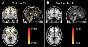 Image result for High Altitude Edema