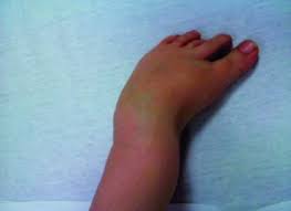 Clubfoot is a birth defect where one or both feet are rotated inward and downward. Clubfoot Deformities Get A Full Range Of Understanding Aapc Knowledge Center