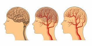 Vascular Eds Can Present With Atypical Headaches Report Suggests