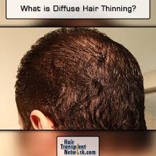 It is one of the most dreaded problems faced by a majority of people, irrespective of gender. Pin On Hair Transplantation Clinics