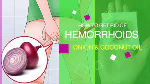 How To Treat Hemorrhoids With Onion Coconut Oil Fast Youtube Hemorrhoids Hemorrhoids Treatment Getting Rid Of Hemorrhoids