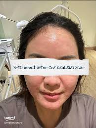 Hari Pertama Setelah Laser CO2 Fractional: Proses Penyembuhan & Harapan