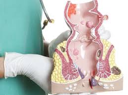 The acute management of haemorrhoids. Thrombosed Hemorrhoids Symptoms Causes And Outlook